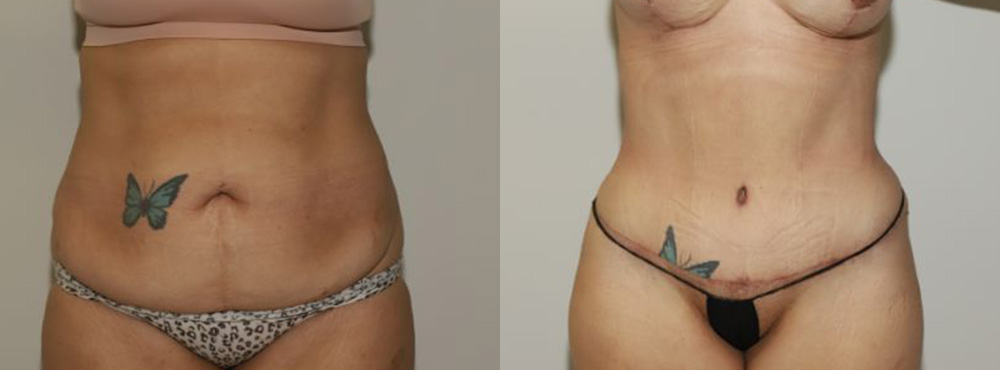 Tummy Tuck before and after in miami