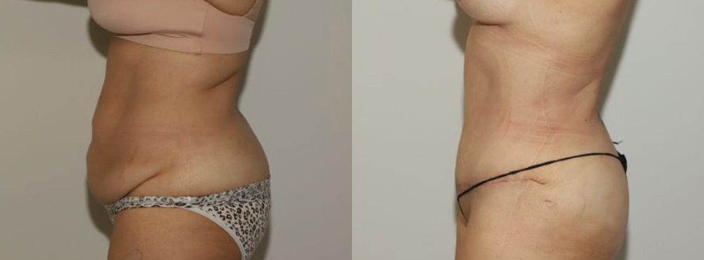 Tummy Tuck before and after in miami