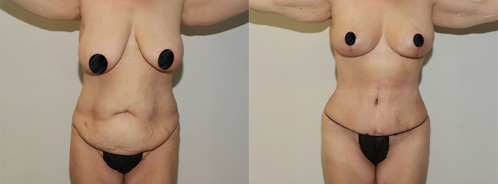 Mommy Makeover Before and After