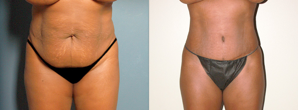 Tummy Tuck Before and After