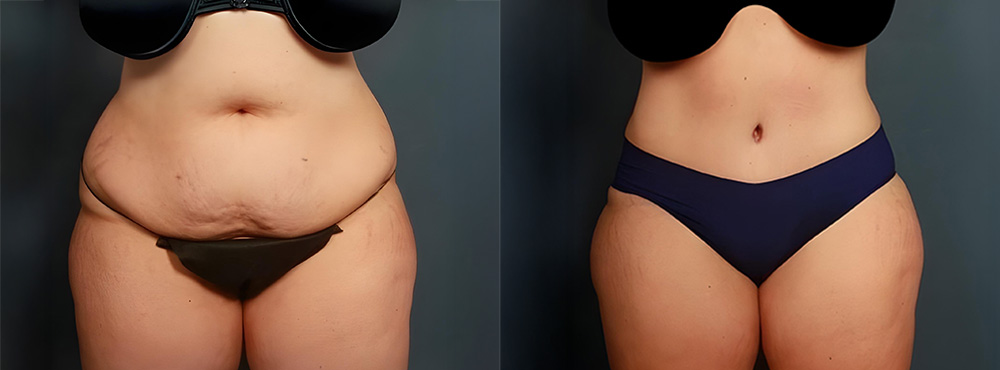 Tummy Tuck before and after