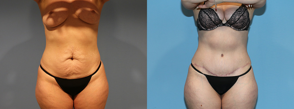 Tummy Tuck Before and After