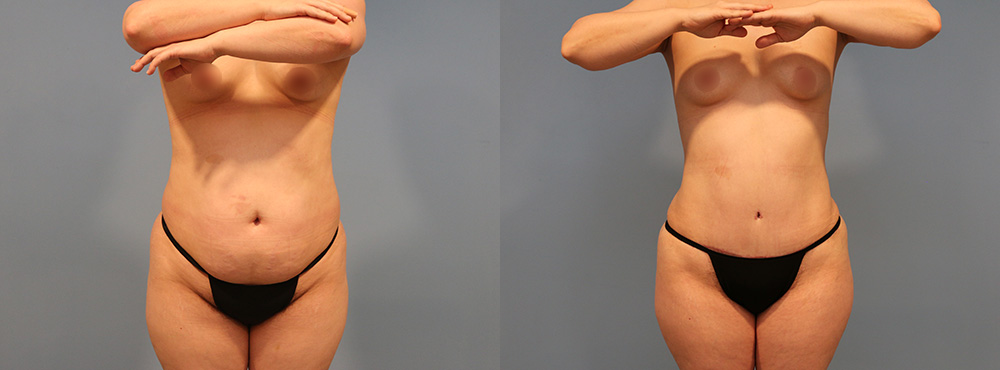 Tummy Tuck Before and After