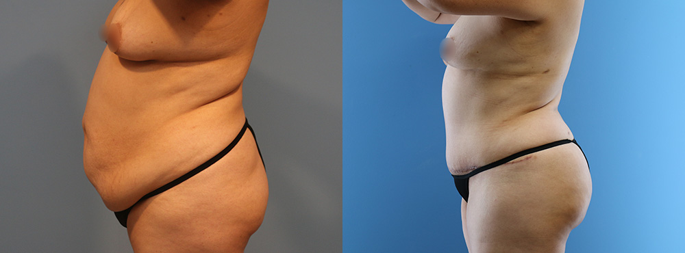 Tummy Tuck Before and After