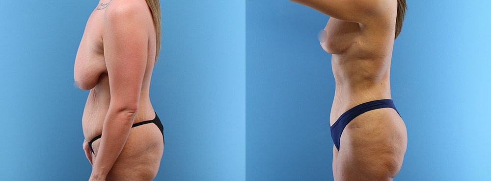 Mommy Makeover Before and After