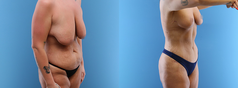 Mommy Makeover Before and After