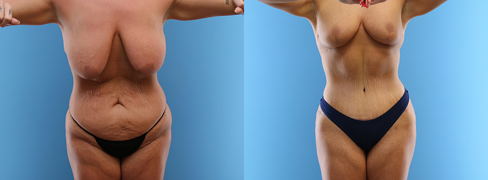 Mommy Makeover Before and After