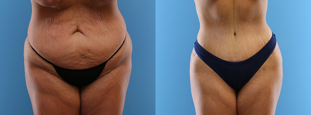 tummy Tuck Before and after