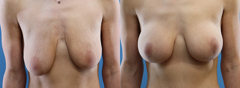 Breast Lift Before and After
