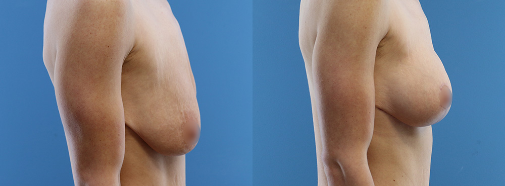 Breast Lift Before and After