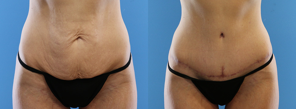 Tummy Tuck Before and After