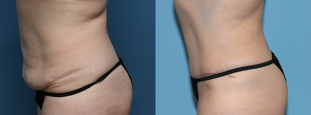 Tummy Tuck Before and After