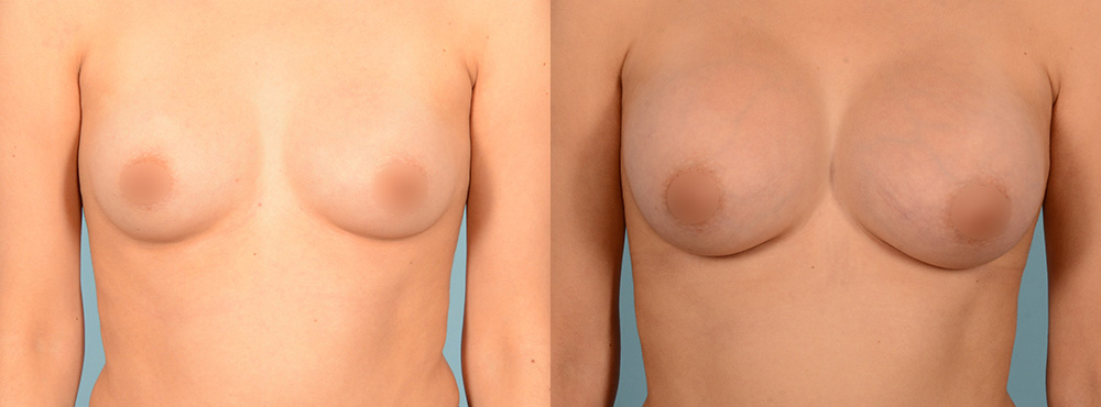 Breast Augmentation before and after