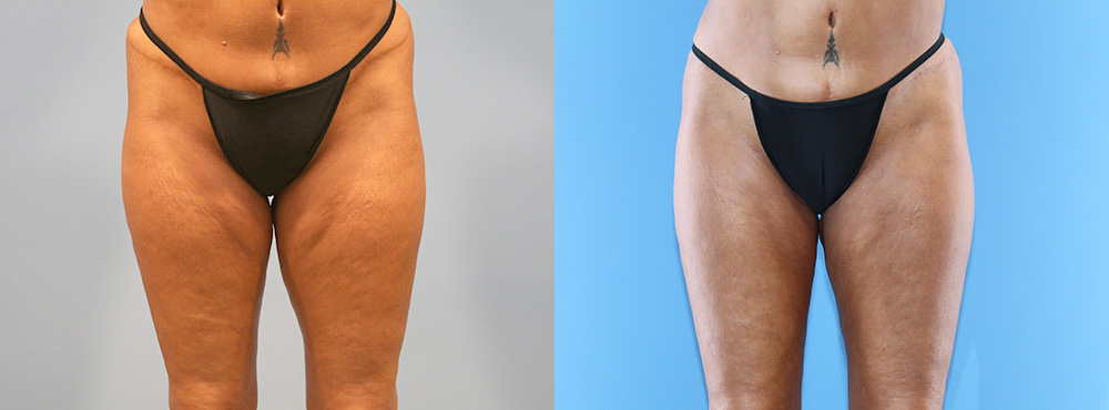 Thigh Lift Before and After