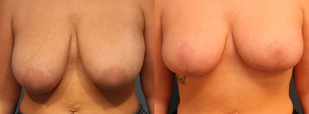 Breast Lift Before and After