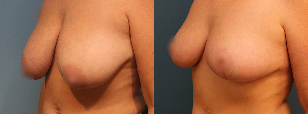Breast Lift Before and After