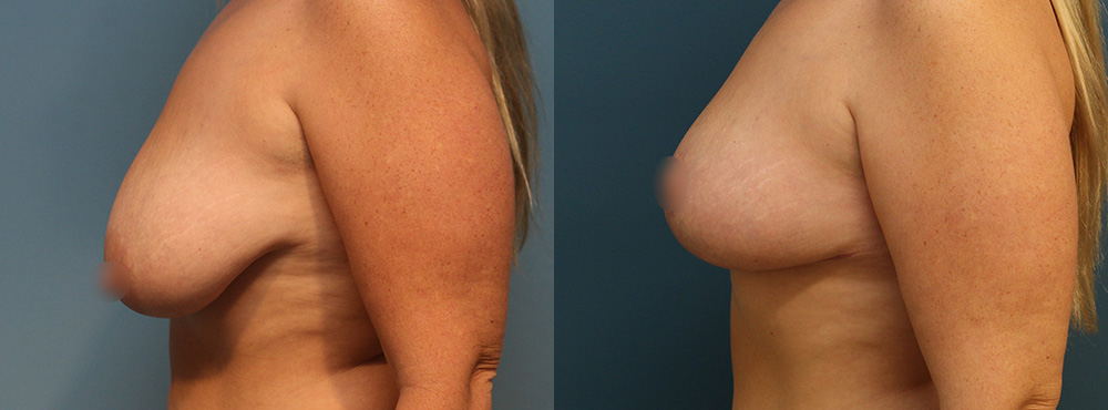 Breast Lift Before and After