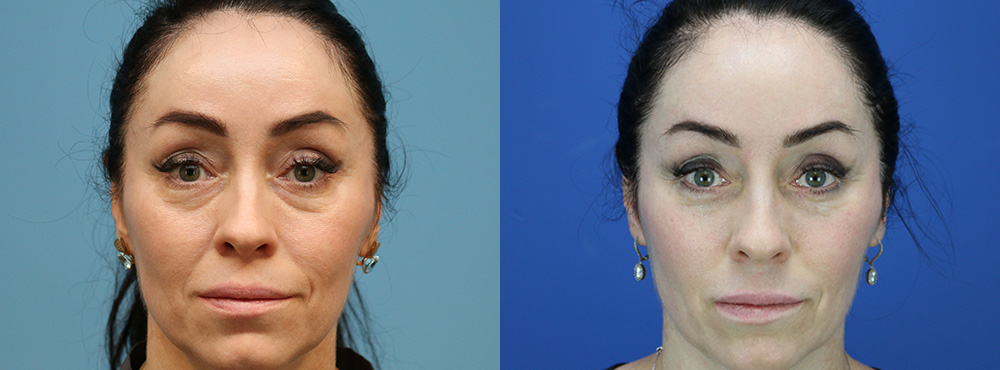 Blepharoplasty Before and After