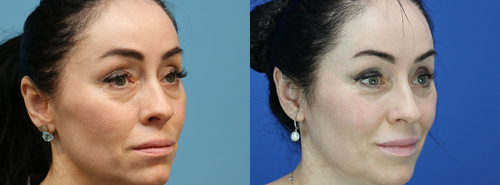Blepharoplasty Before and After