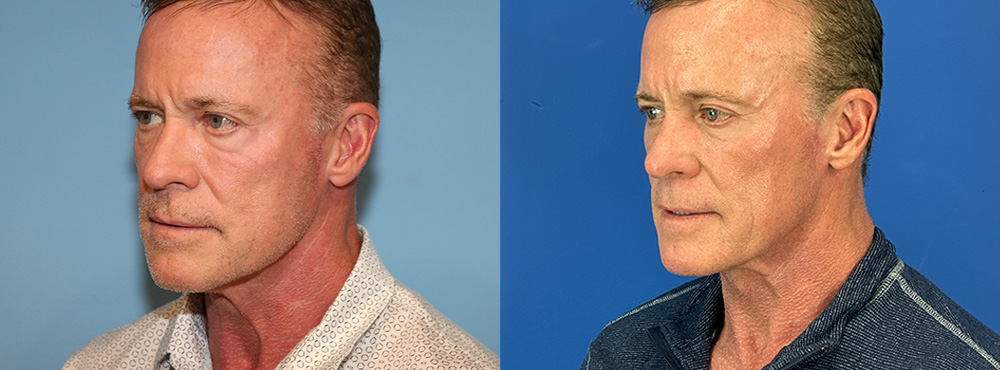 Neck Lift Before And After