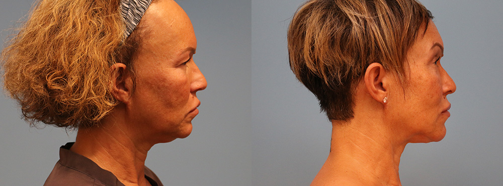 Chin Lipo Before and After
