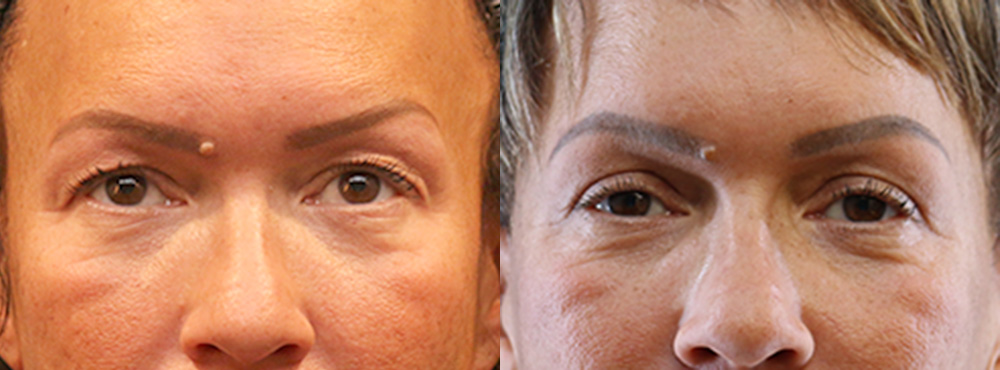 Blepharoplasty Before and After