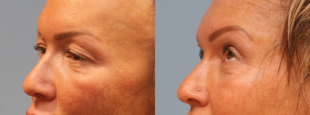 Blepharoplasty Before and After
