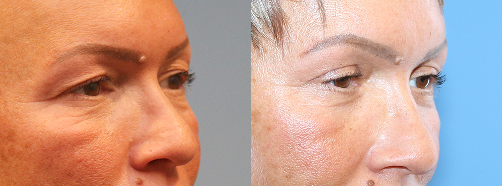 Blepharoplasty Before and After
