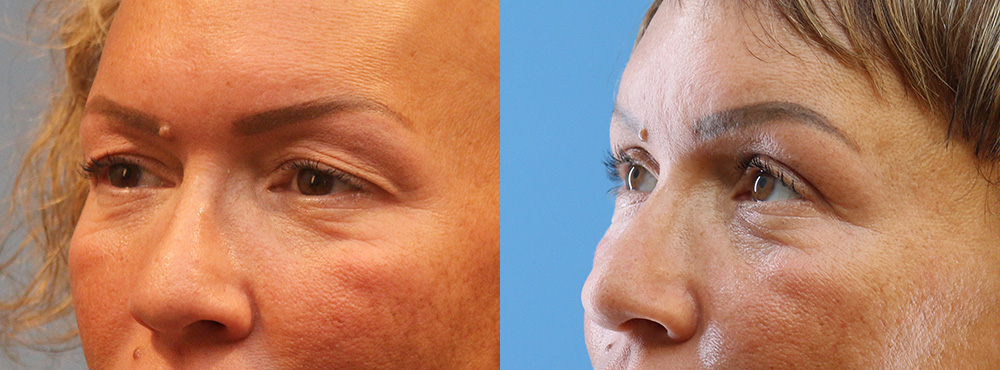 Blepharoplasty Before and After