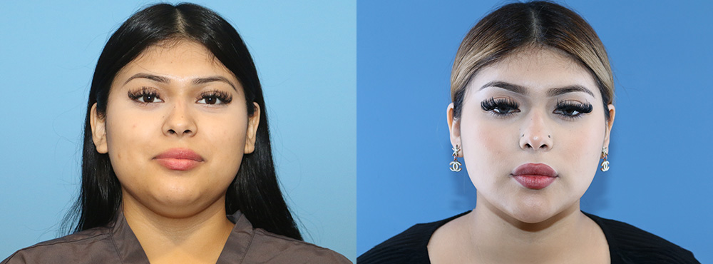Chin Lipo Before and After