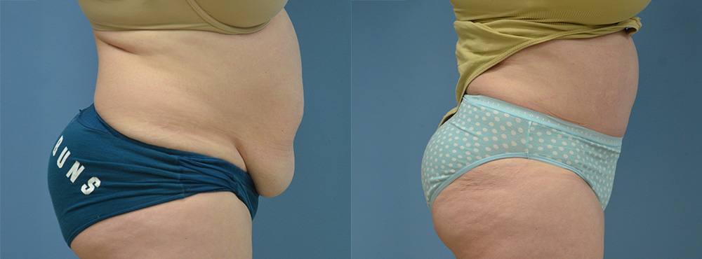 Tummy Before and After