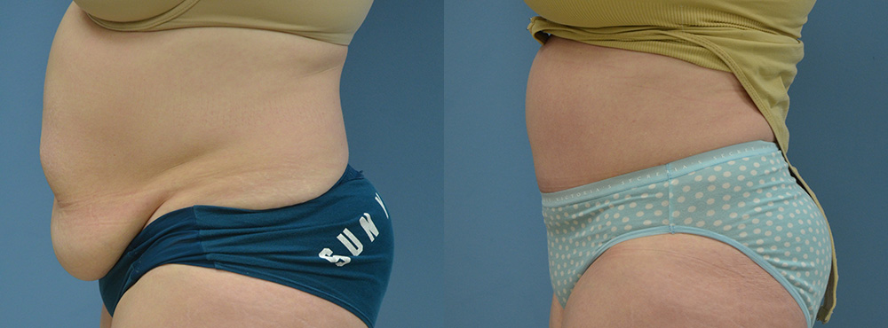 Tummy Before and After