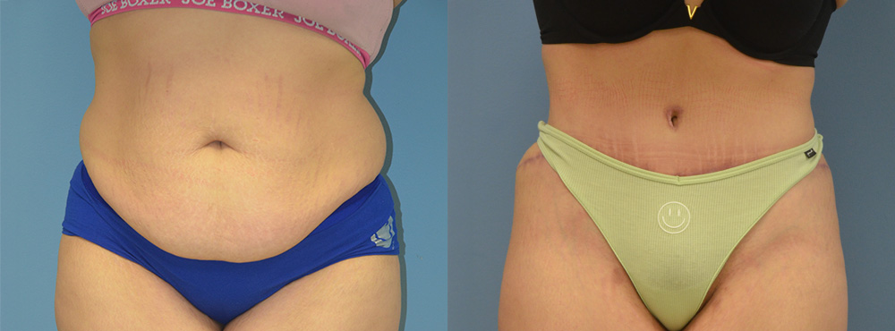 Tummy Tuck Before and After