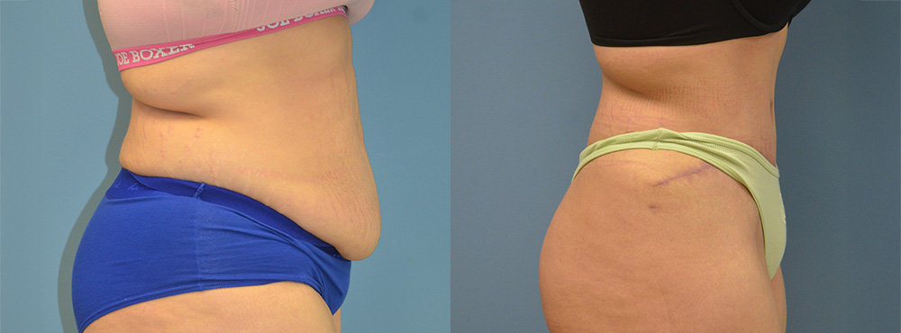 Tummy Tuck Before and After