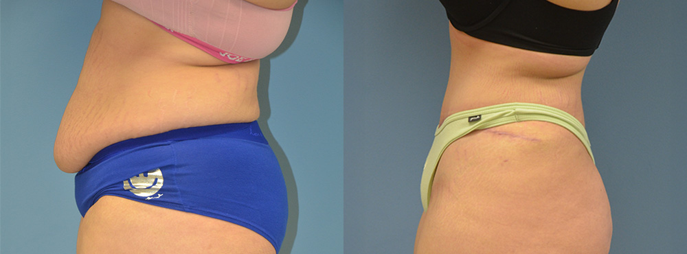 Tummy Tuck Before and After