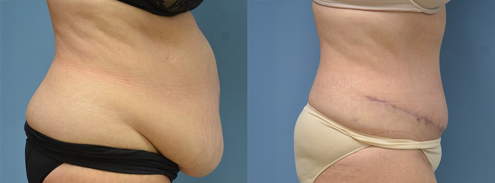 Tummy Tuck Before and After