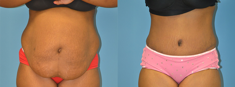 Tummy Tuck Before and After