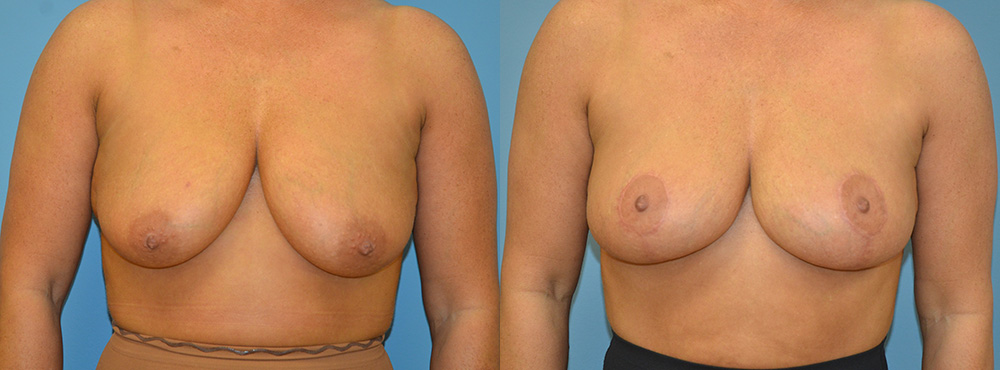Breast Lift Before and After
