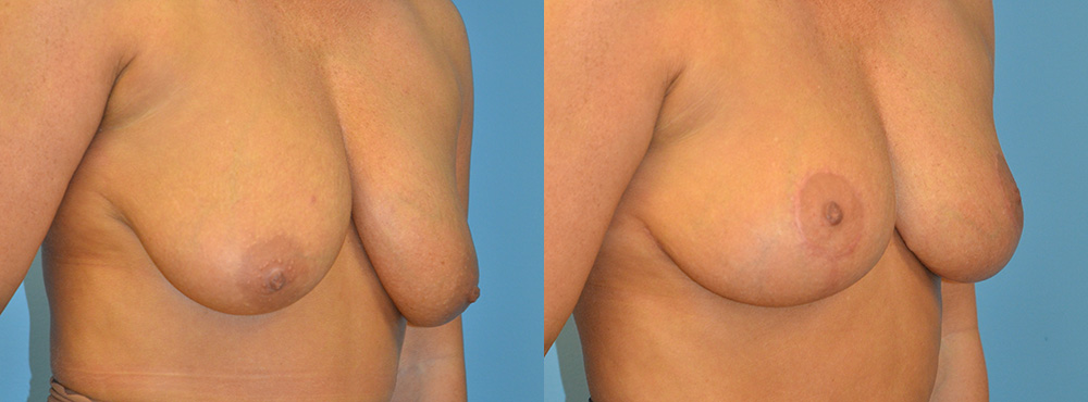 Breast Lift Before and After