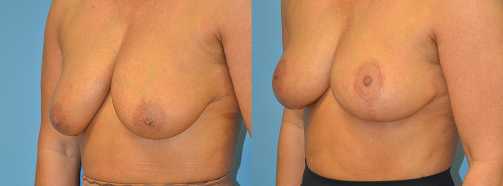 Breast Lift Before and After