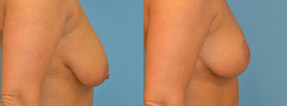 Breast Lift Before and After