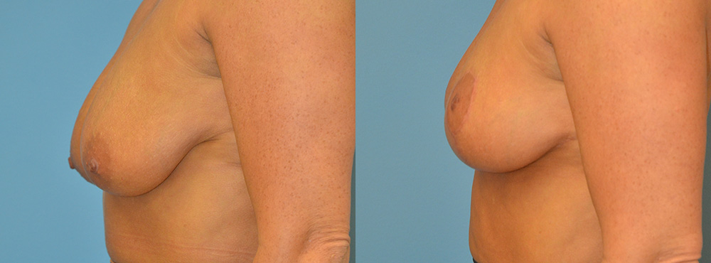 Breast Lift Before and After
