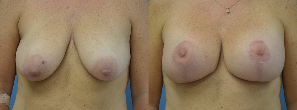 Breast Lift Before and After