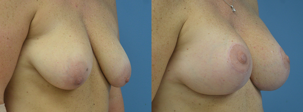 Breast Lift Before and After