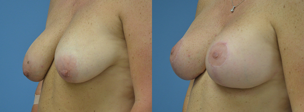 Breast Lift Before and After
