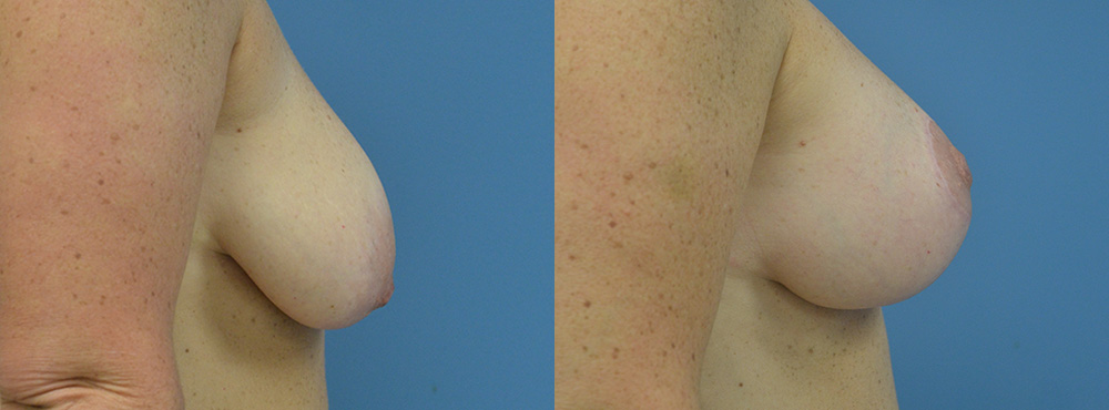 Breast Lift Before and After