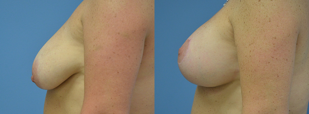 Breast Lift Before and After