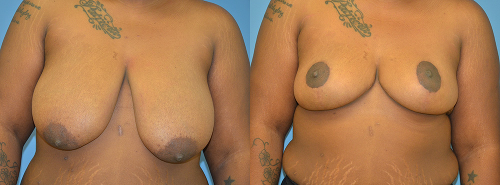 Breast Lift Before and After