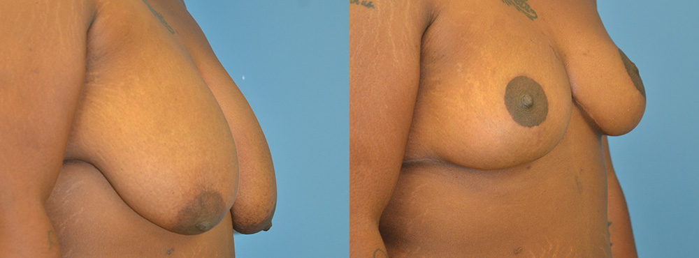Breast Lift Before and After