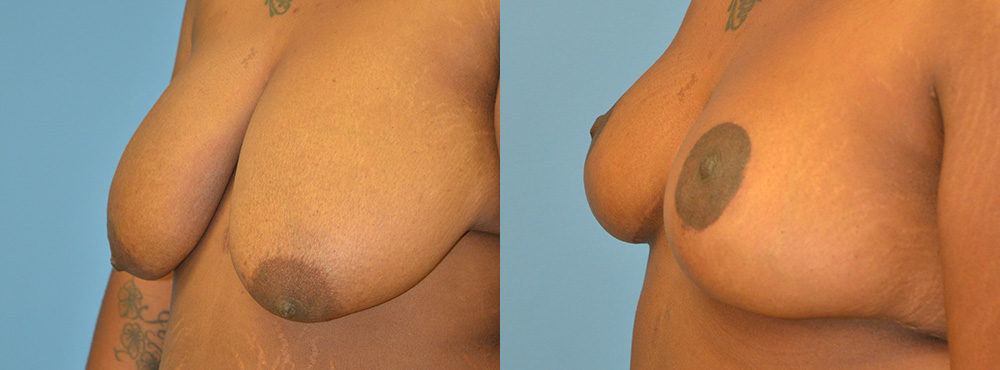 Breast Lift Before and After